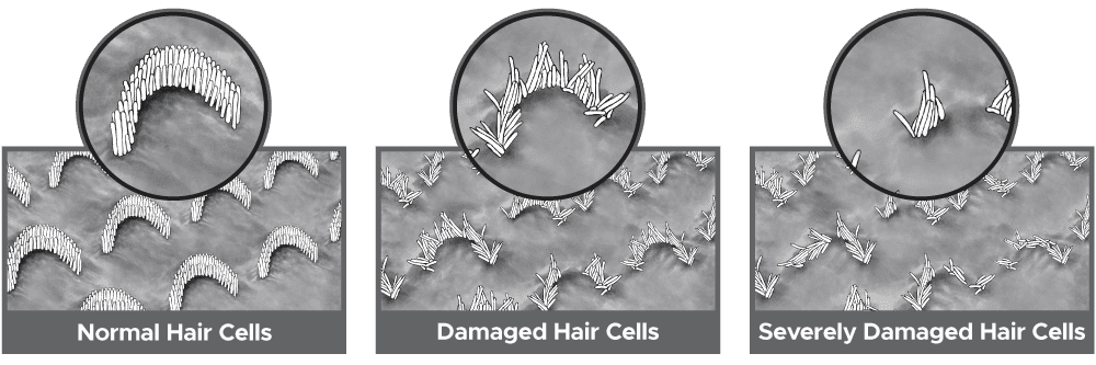Inner hair cells and damage